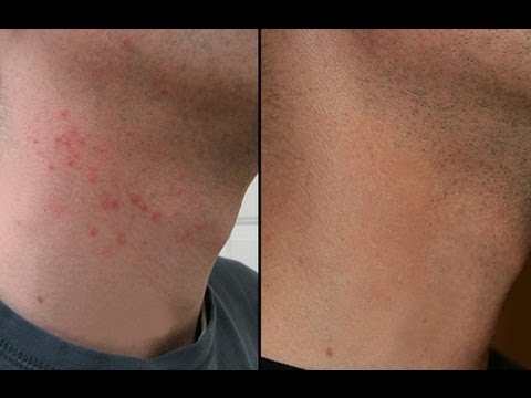How To Get Rid Of Razor Bumps On Neck