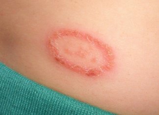 how to get rid of ringworm