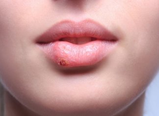 What Causes The Cold Sores