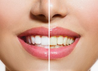 In Office vs At-Home Whitening Your Best and Brightest Smile Awaits