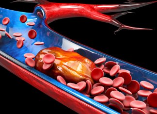 Keep it Flowing The Top Must-Know Tips to Prevent Blood Clots