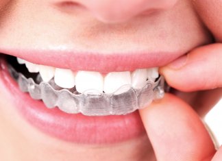 Invisalign Braces