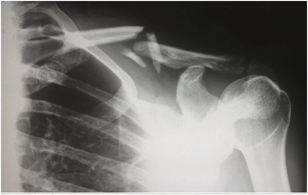 An X-ray of a shoulder
